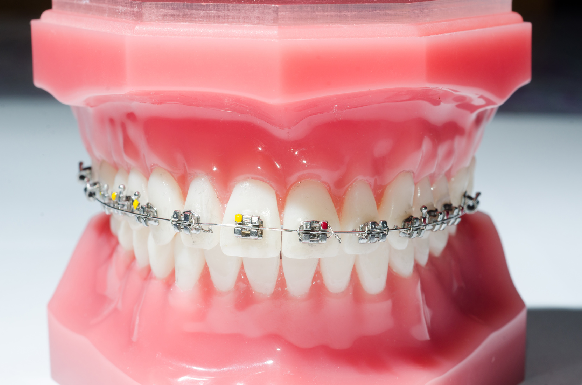 歯の表面に金具をつける矯正治療