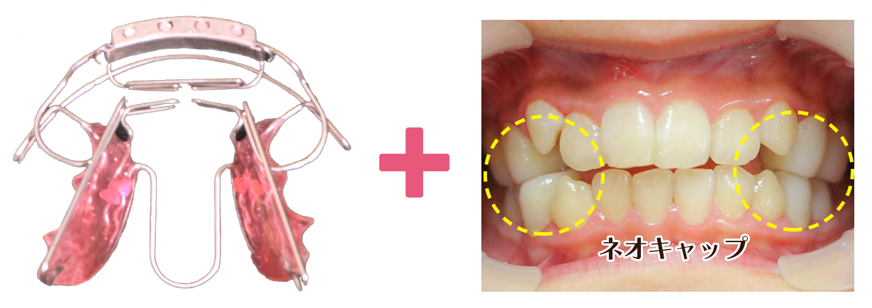 ネオキャップビムラー