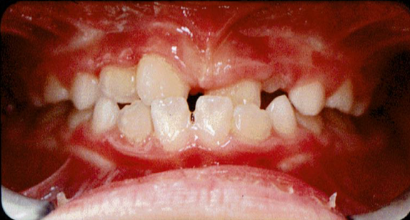 佐藤くんの矯正治療1