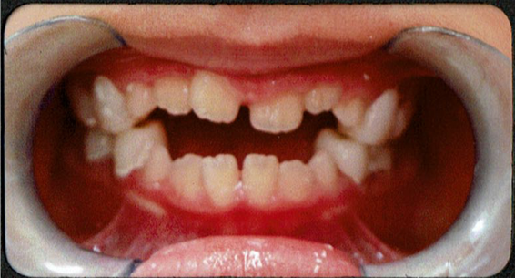 佐藤くんの矯正治療2