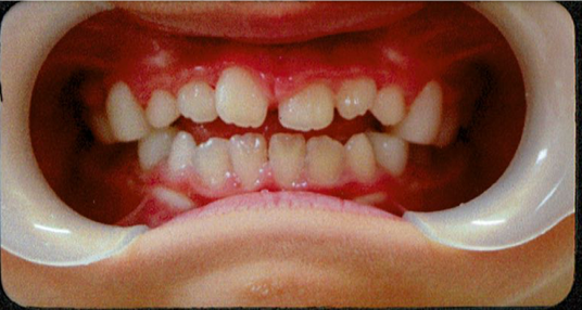 佐藤くんの矯正治療5