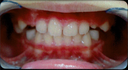 佐藤くんの矯正治療6