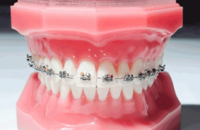 子どもの歯並びはマウスピース矯正で治療できるのか